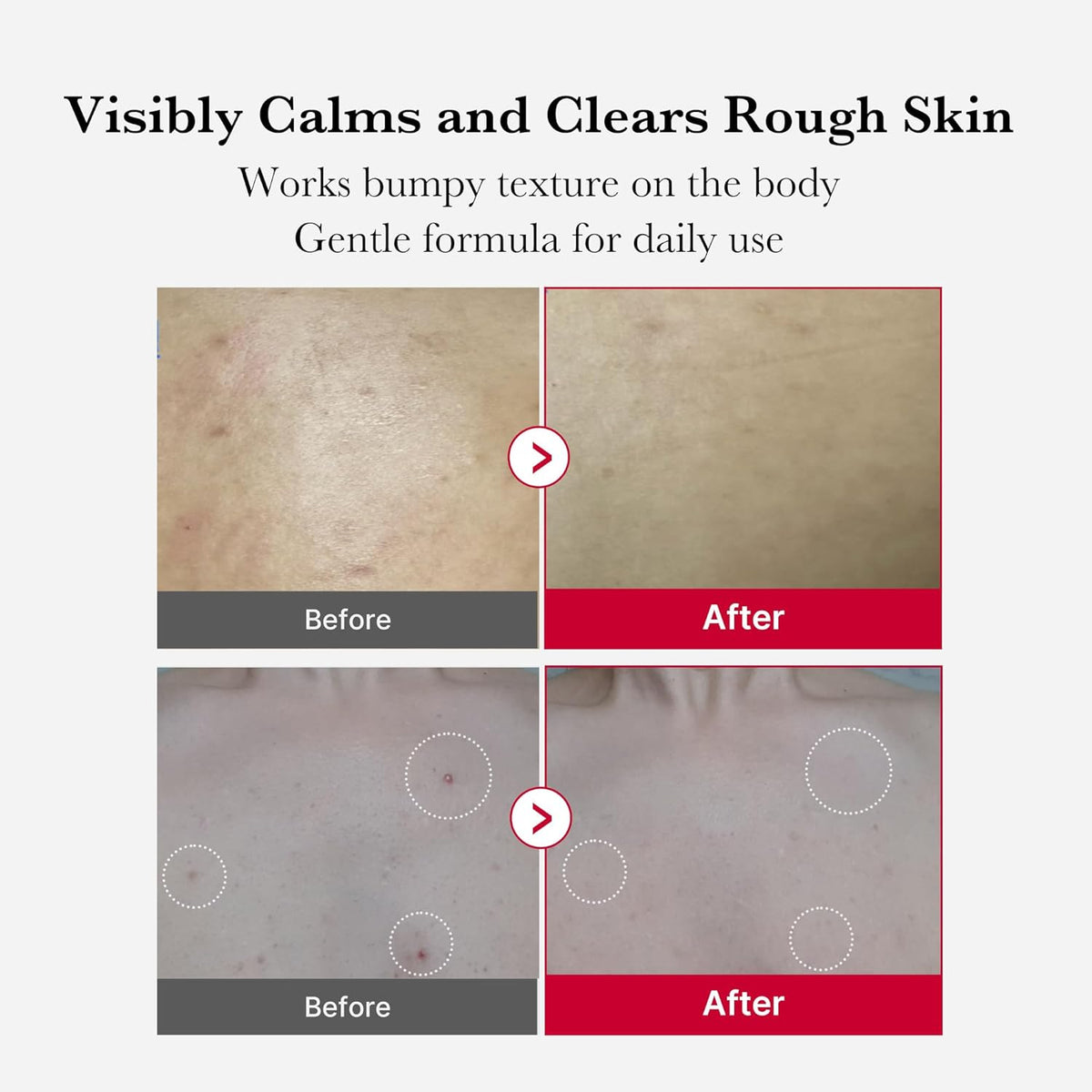 Medicube - Red Acne Body Peeling Shot 2.0 110g